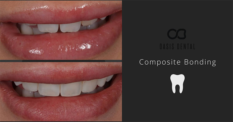Before and after shot of having Composite bonding.