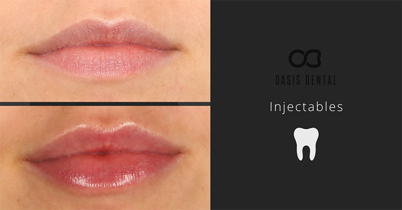 Before and after shot of having cosmetic injectables.