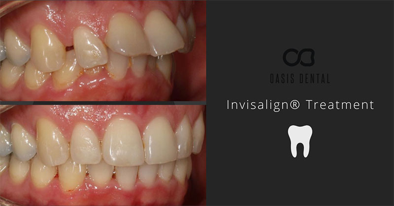 Before and after shot of having Invisalign Treatment.